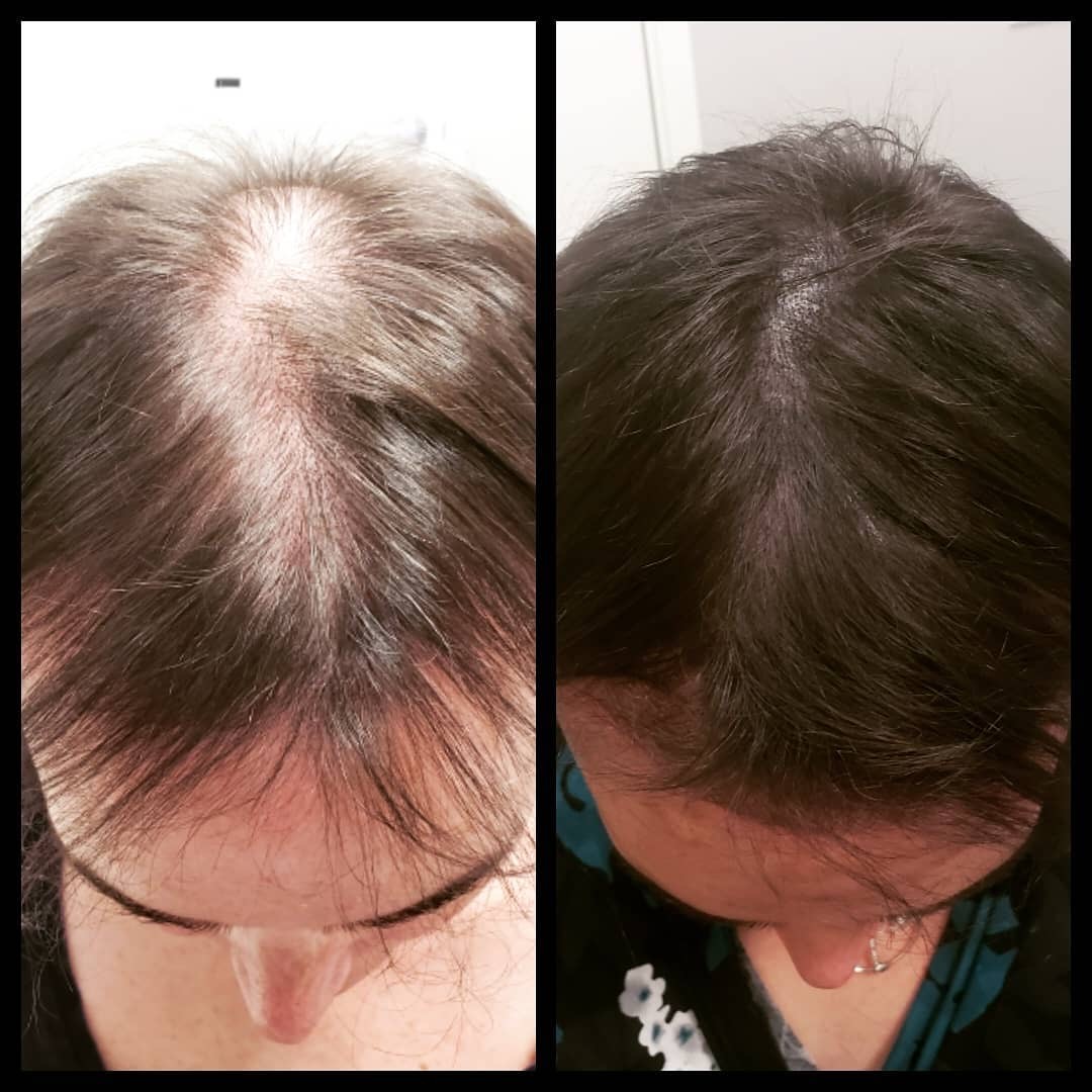 Hair loss treatment