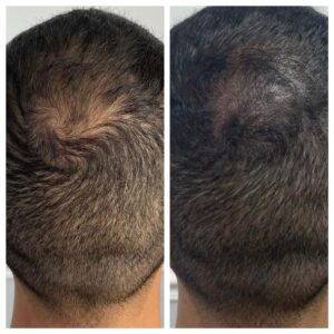 Hair loss solution