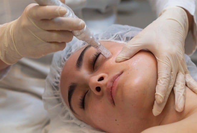 microneedling-mesotherapy