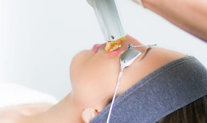 laser-facial hair laser removal. PCOS hair removal laser