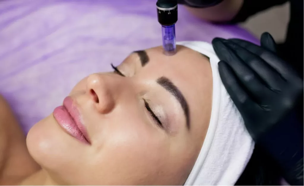 Microneedling-montreal-mesotherapy
