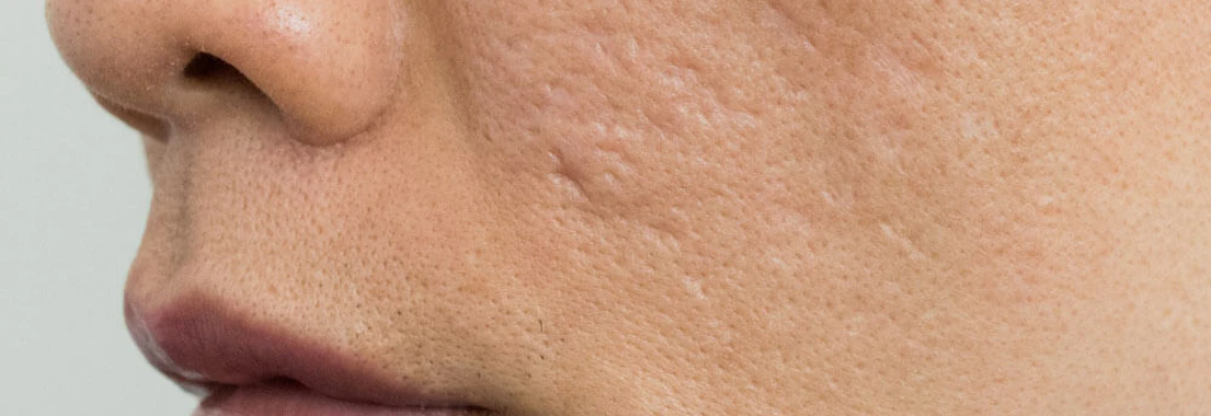 acne scars microneedling-acne kystique
