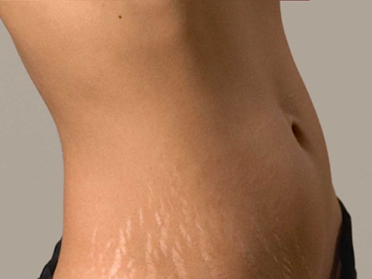 Stretch marks Vergetures