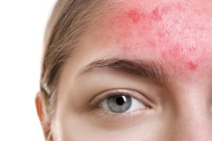 treatment-acne-rosacea