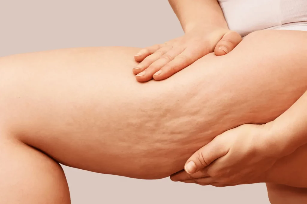 Treatments for cellulite montreal