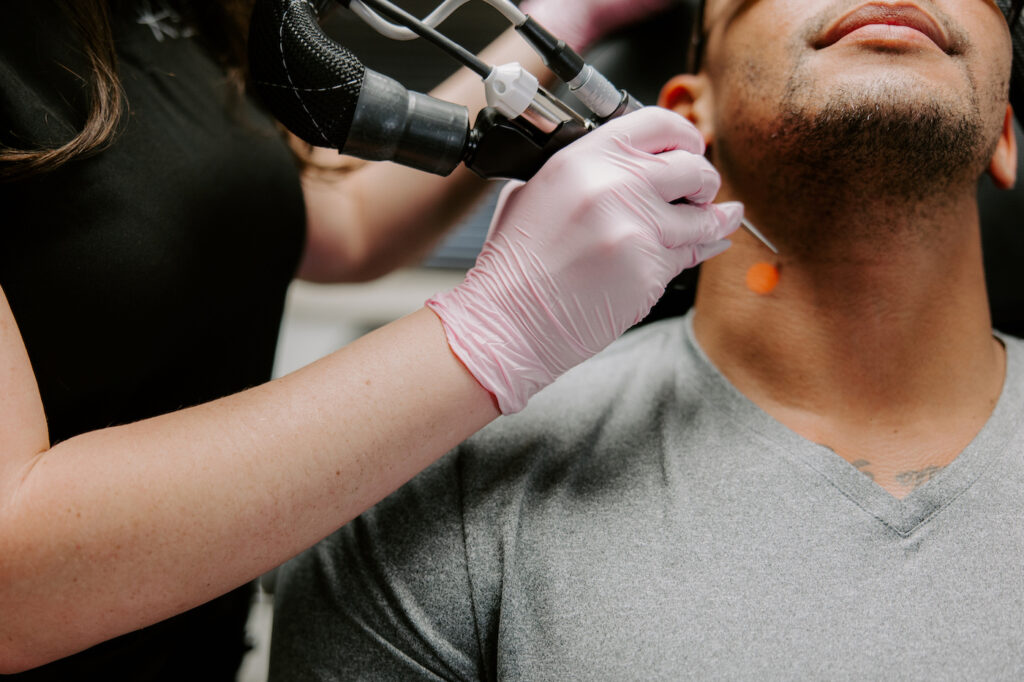 men facial hair laser removal