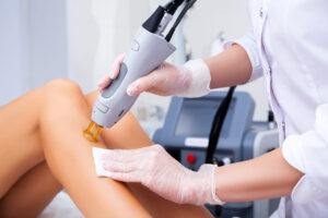hair removal laser in montreal