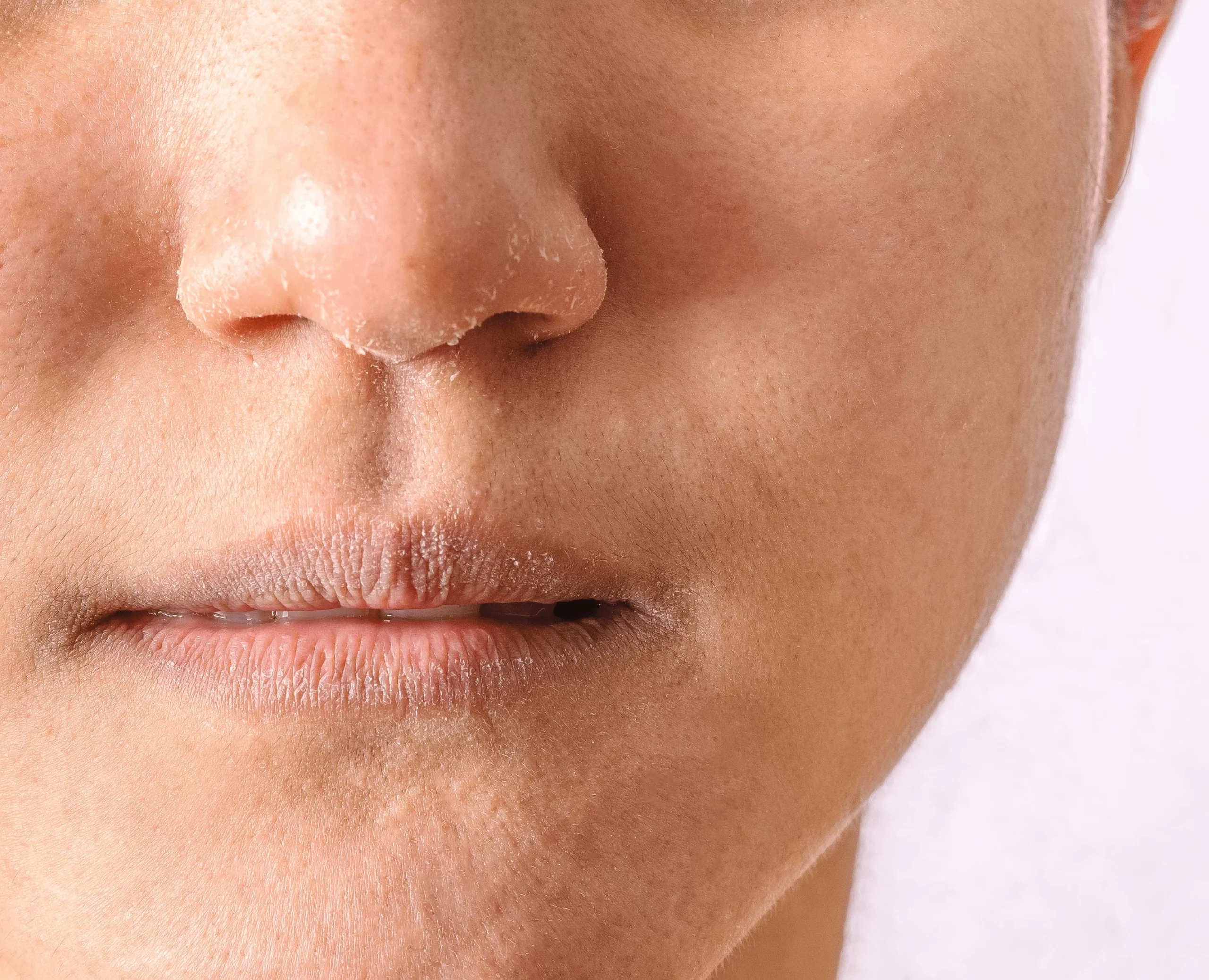 texture skin tone Large Pores Treatment