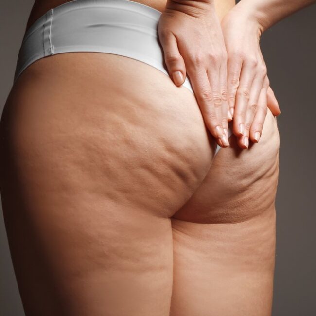 Cellulite  traitement pour la cellulite  traitement cellulite