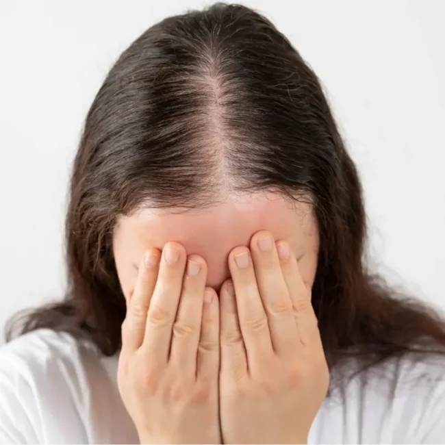 Hair Loss Women Benev Exsosomes