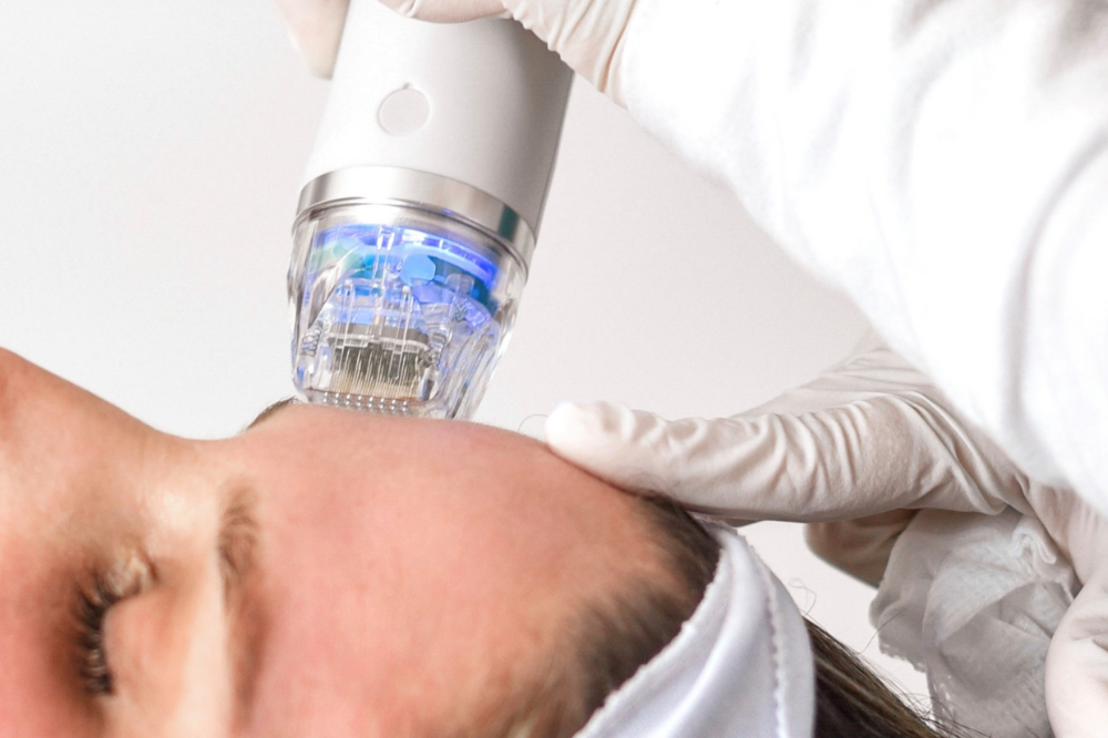 Microneedling RF Montreal facial treatments