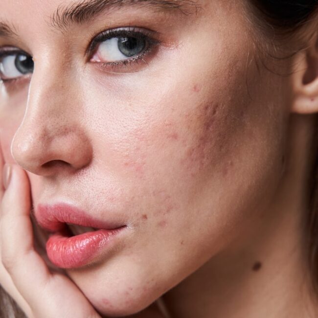 acne scars face