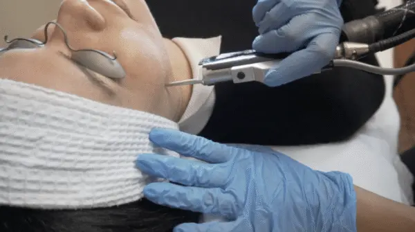 L'Épilation au Laser Montréal