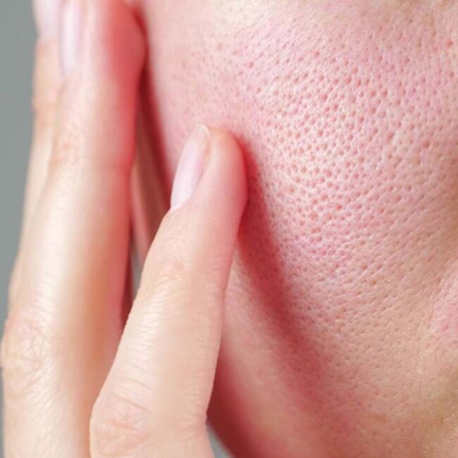 pores enlarged Large Pores Treatment