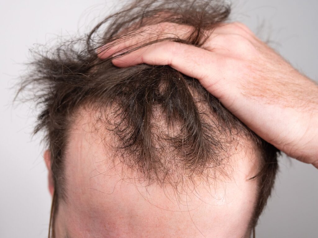 Hair Loss-exosomes-PRP hair treatment Montreal