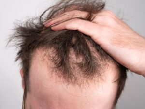 Hair Loss exosomes PRP hhair treatment Montreal