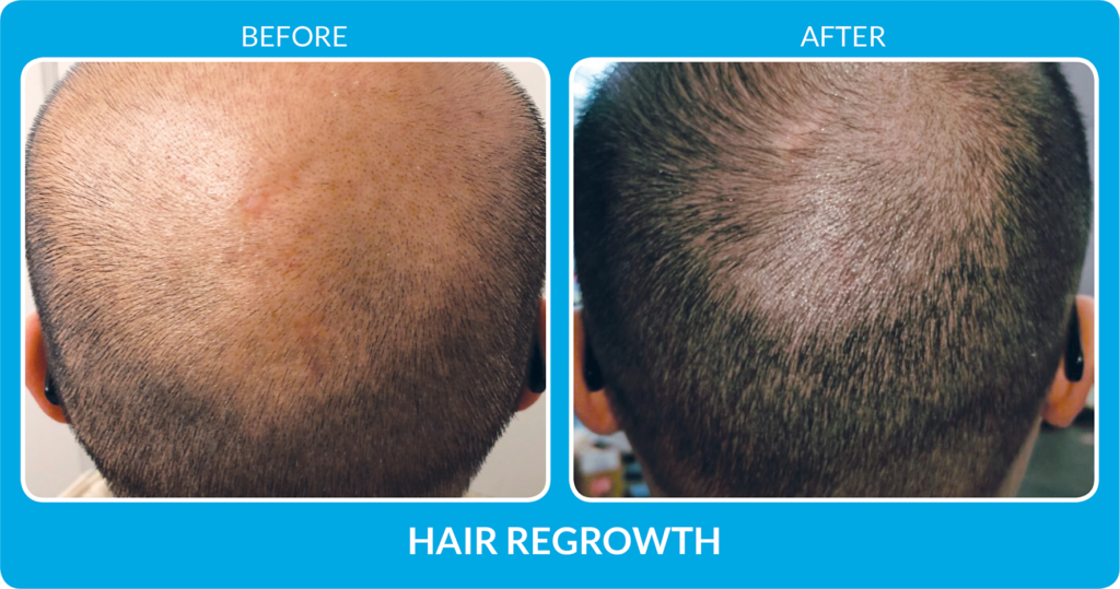 Hair Loss Treatment Benev Exosomes