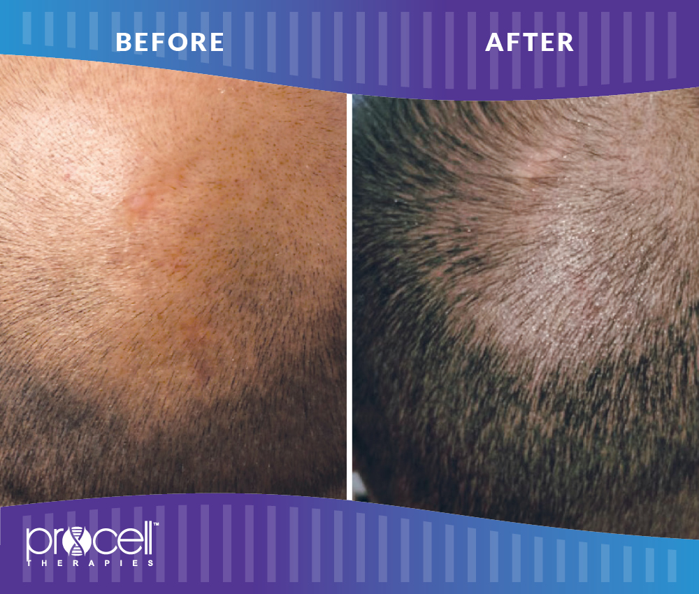 Hair Loss Treatment-Benev Exosomes