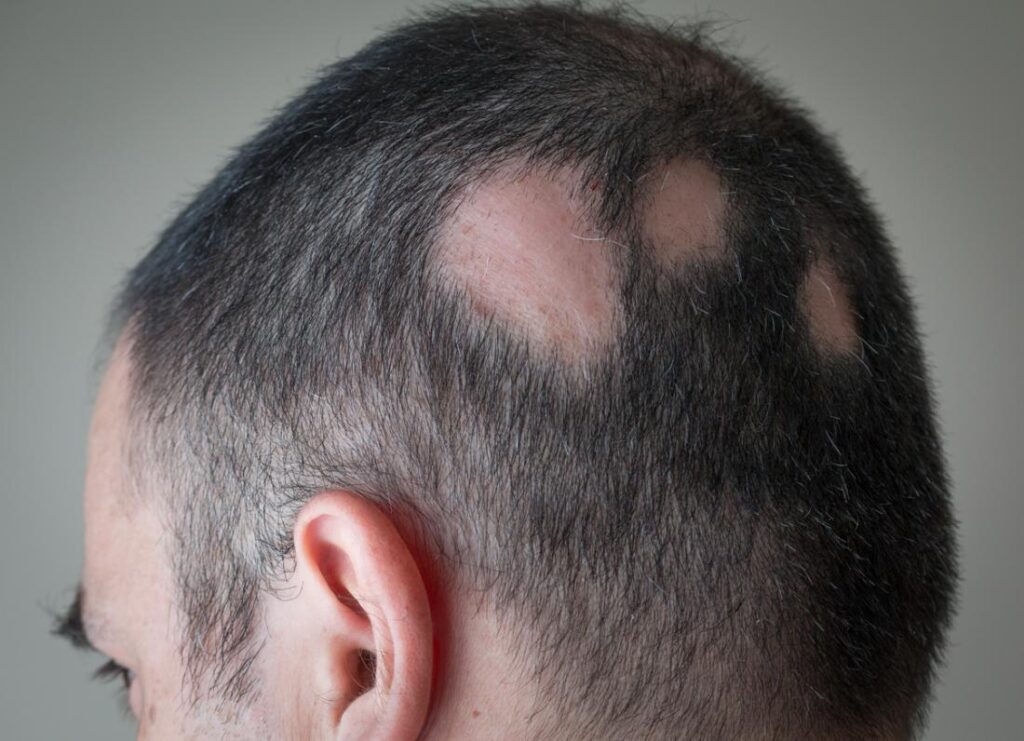 partial-alopecia-hair-loss-Benev Exosomes
