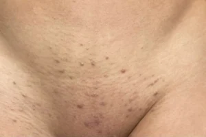 Folliculitus after waxing laser poil