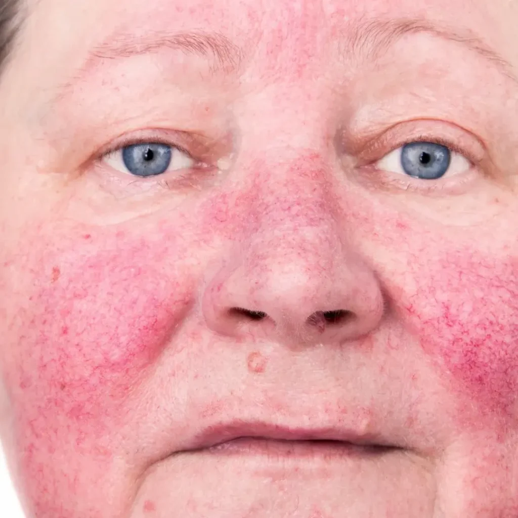 Rosacea Treatments-ROSACÉE traitement