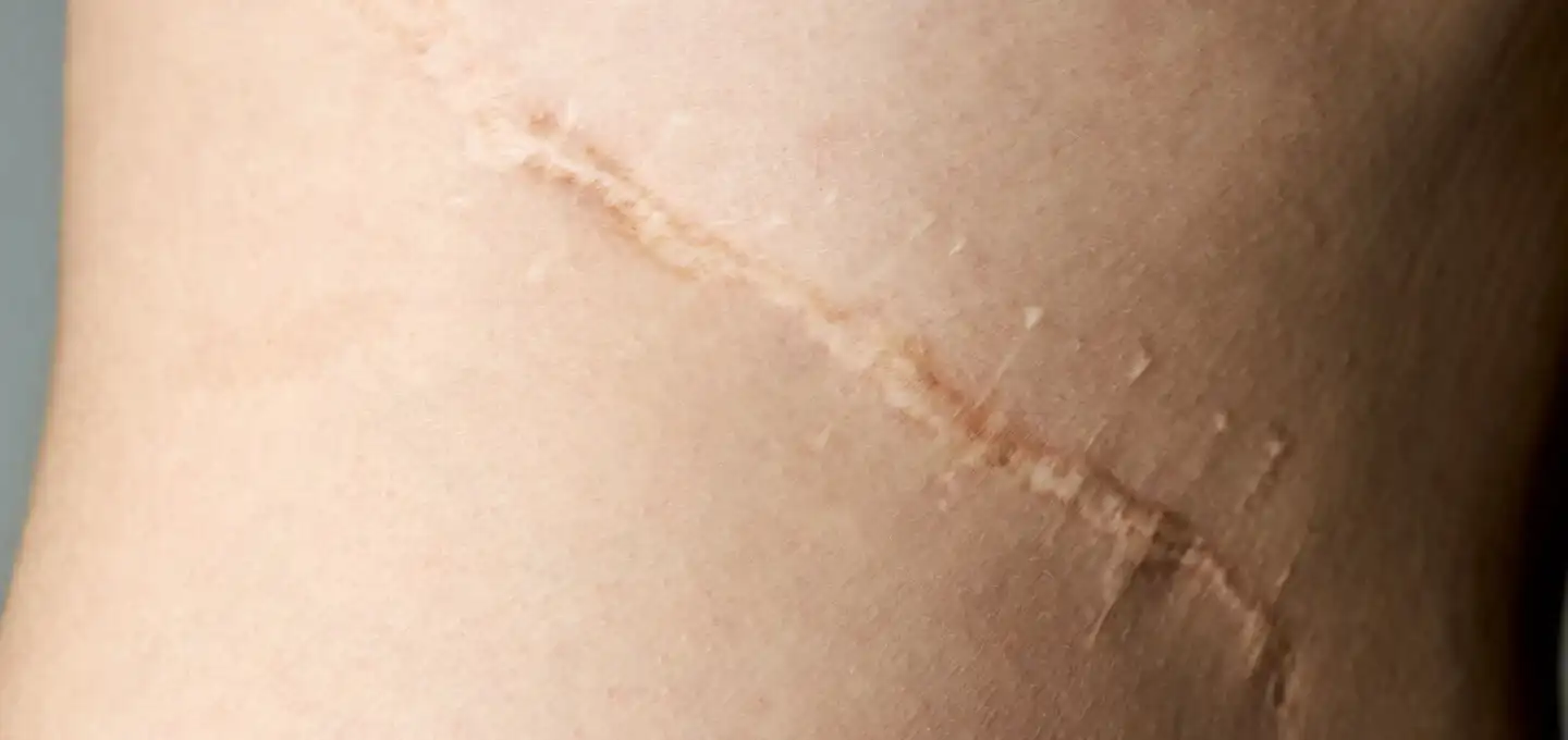 scar treatment Montreal cicatrices acné