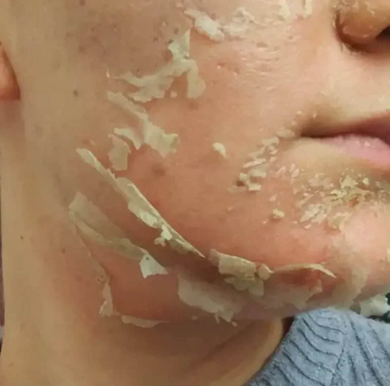 Peel peelings visage Acne algae peel