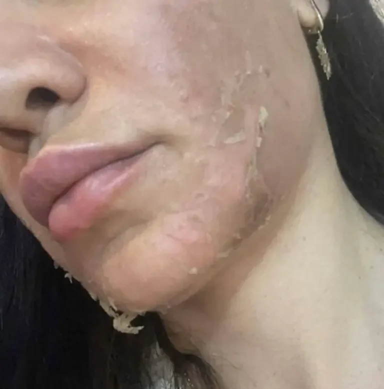 Acne algae peel melasma