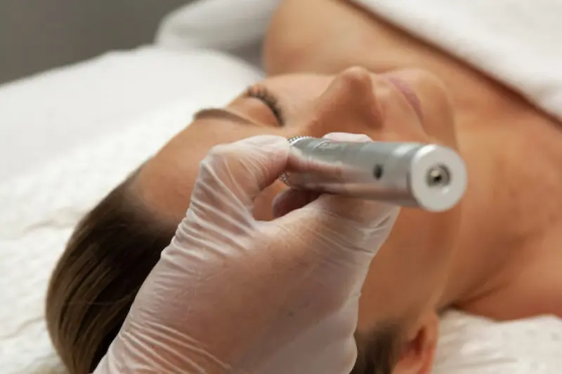 Microneedling-montreal-microdermabrasion in Montreal
