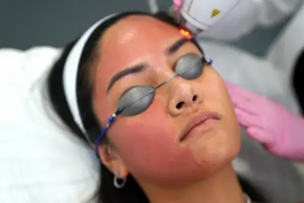 laser skin tightening  rajeunissement au laser