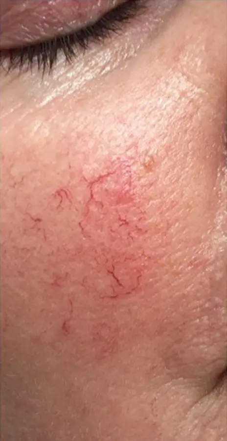 spider veins vein treatment