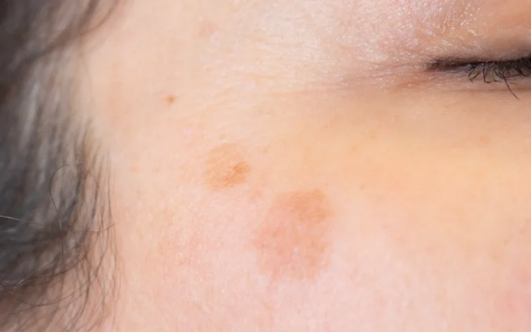 laser dark spots