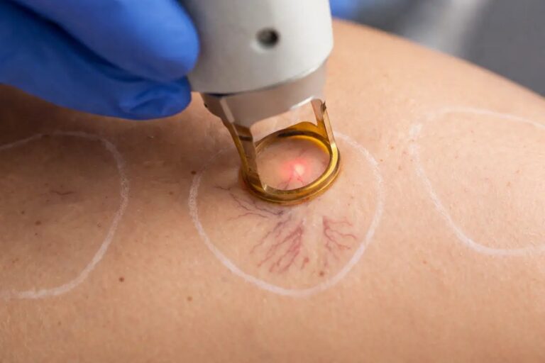 vein treatment spider veins varicosités