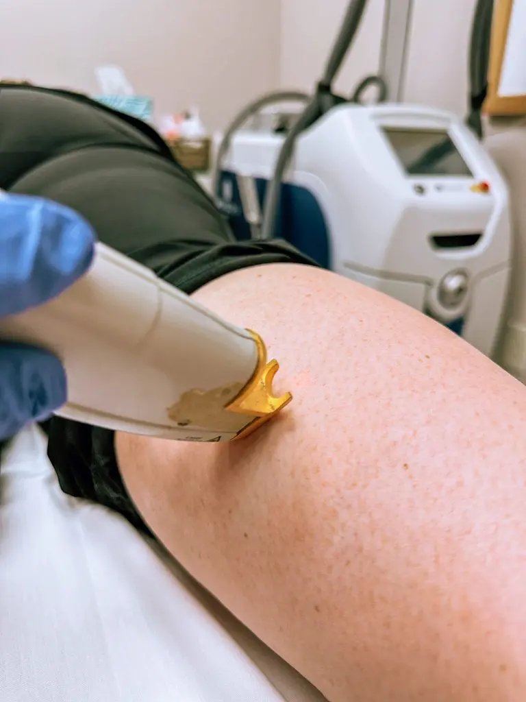 vein treatment