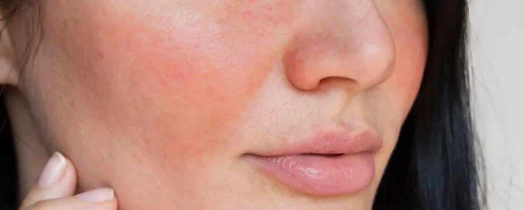 Traitement Couperose-rosacea-Laser Treatment for Rosacea
